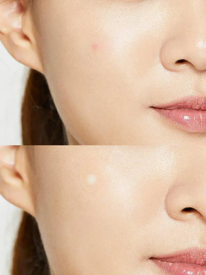 COSRX Acne Pimple Patch - DOKAN