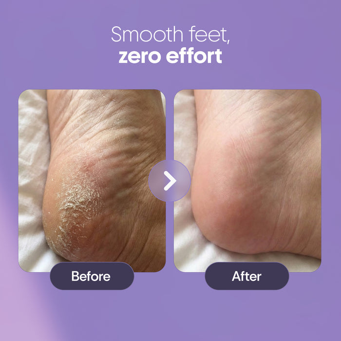 Furr Foot Callus Remover