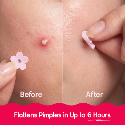 Patch, Don’t Panic - Acne Patches | 30 Pieces